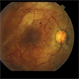 Ischemic Proliferative Diabetic Retinopathy Ischemic Proliferative Diabetic Retinopathy
